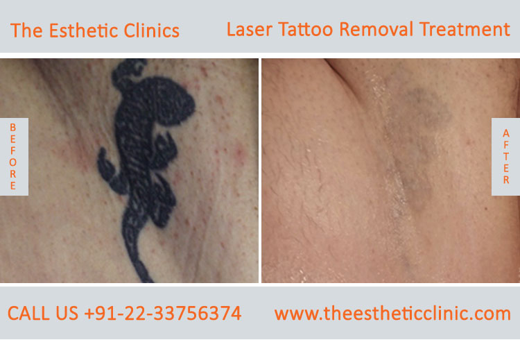 Permanent Laser Tattoo Removal Treatment before after photos in mumbai india (2)